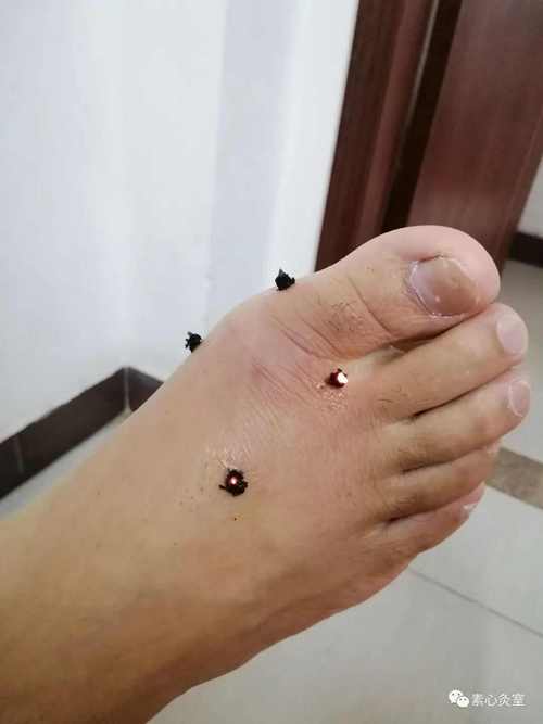 艾灸治疗痛风有效果吗