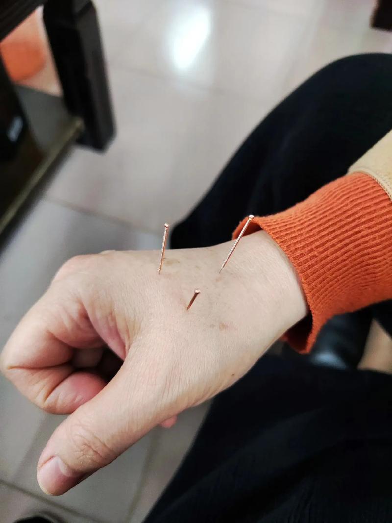 气血不通可以针灸吗