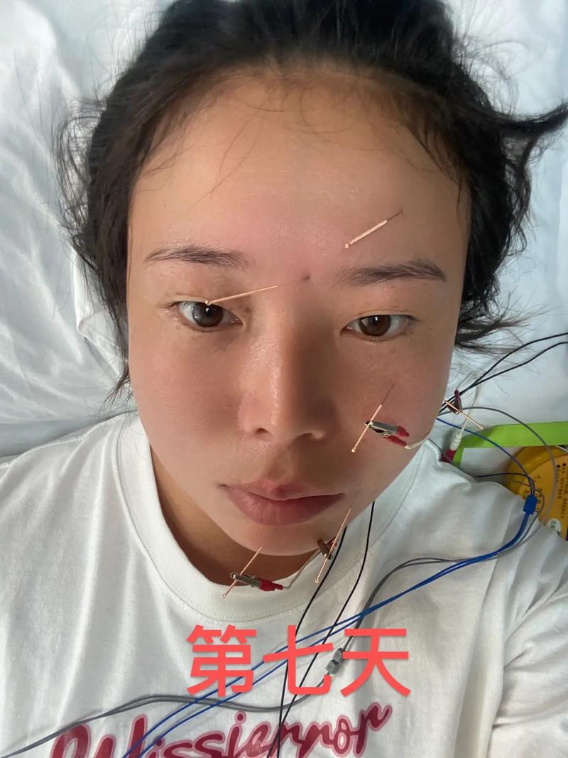 面瘫 针灸 后遗症