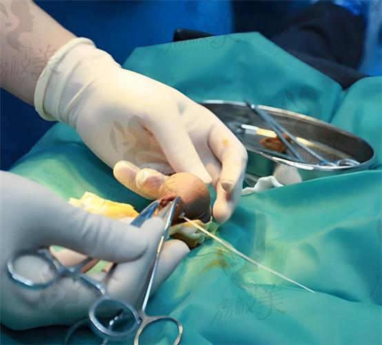 重庆割包皮男健最安全