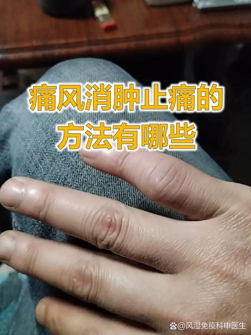 痛风缓解后长时间隐痛
