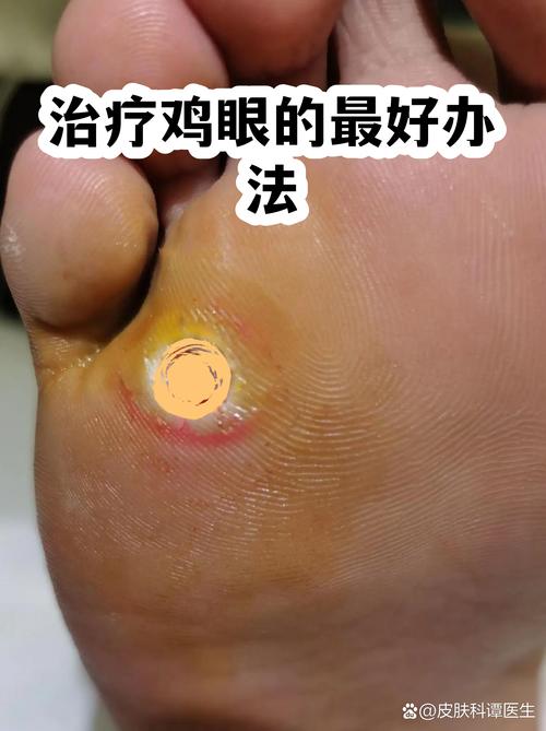 针灸可以治疗鸡眼吗