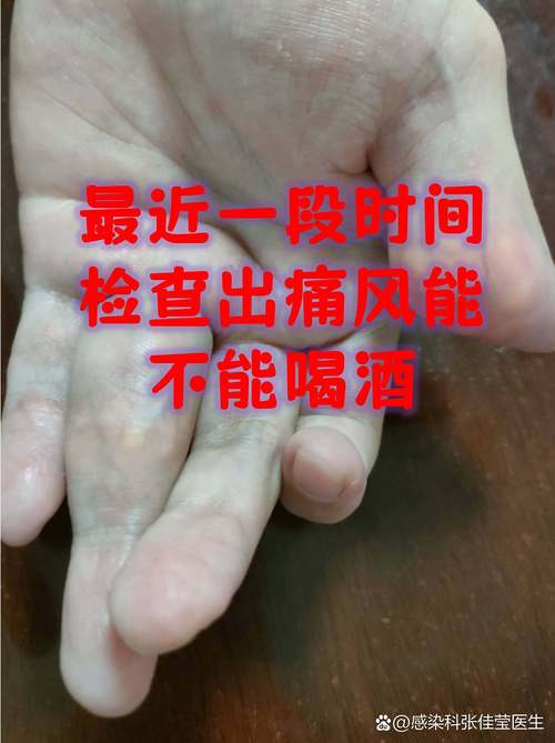 做什么检查能查出痛风