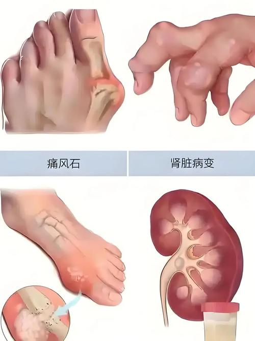 痛风的感觉是什么症状