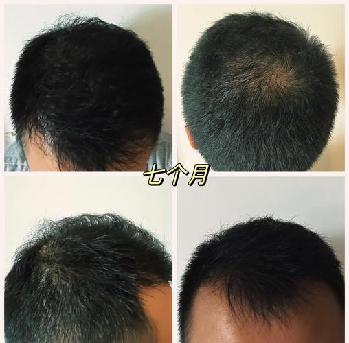 无痕植发海峡植发安全