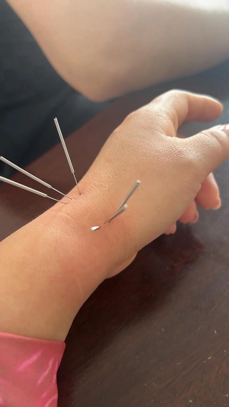 皮肤瘙痒的针灸治疗