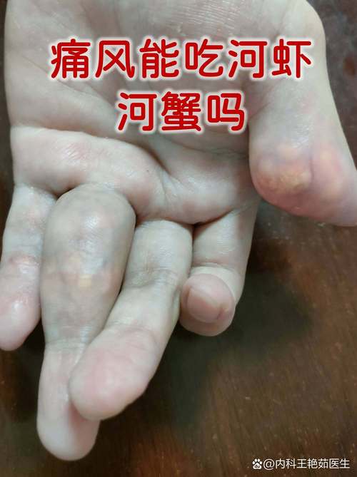 痛风的人可以吃螃蟹吗