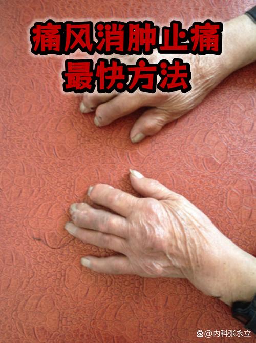 痛风最快的是不是放血