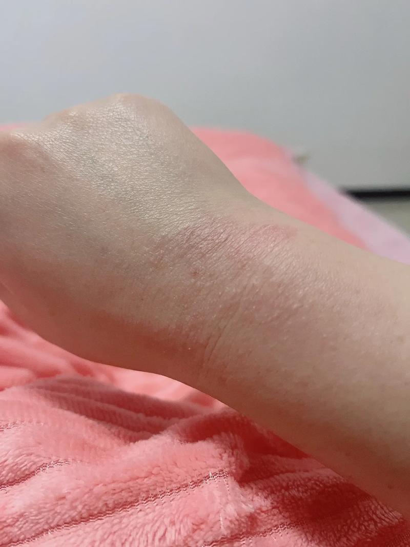 女性对安全套过敏症状