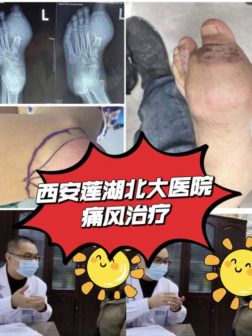 西安痛风哪里治疗最好