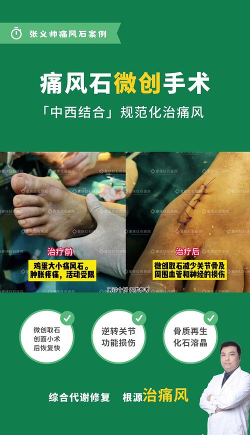 西安痛风哪里治疗最好