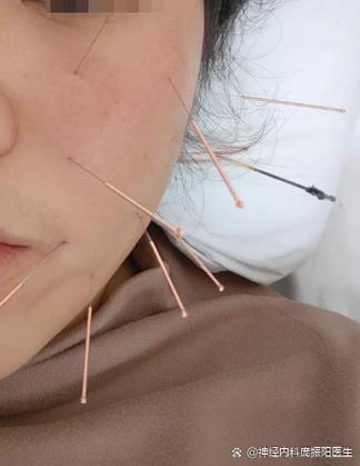 怀孕面瘫可以针灸吗