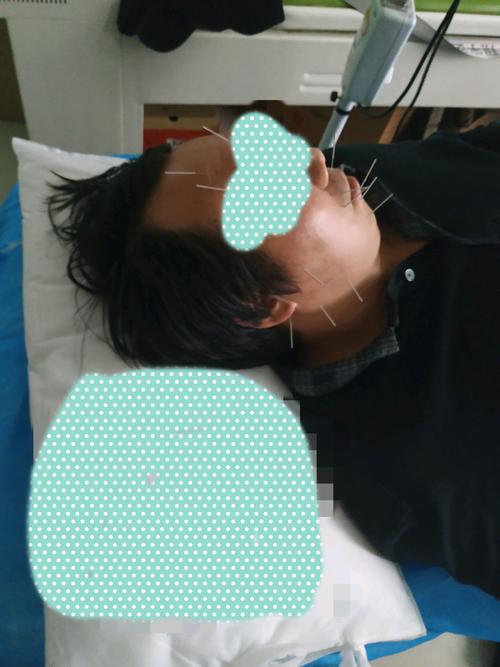 面瘫针灸用电针好吗