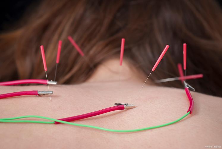 面瘫针灸用电针好吗