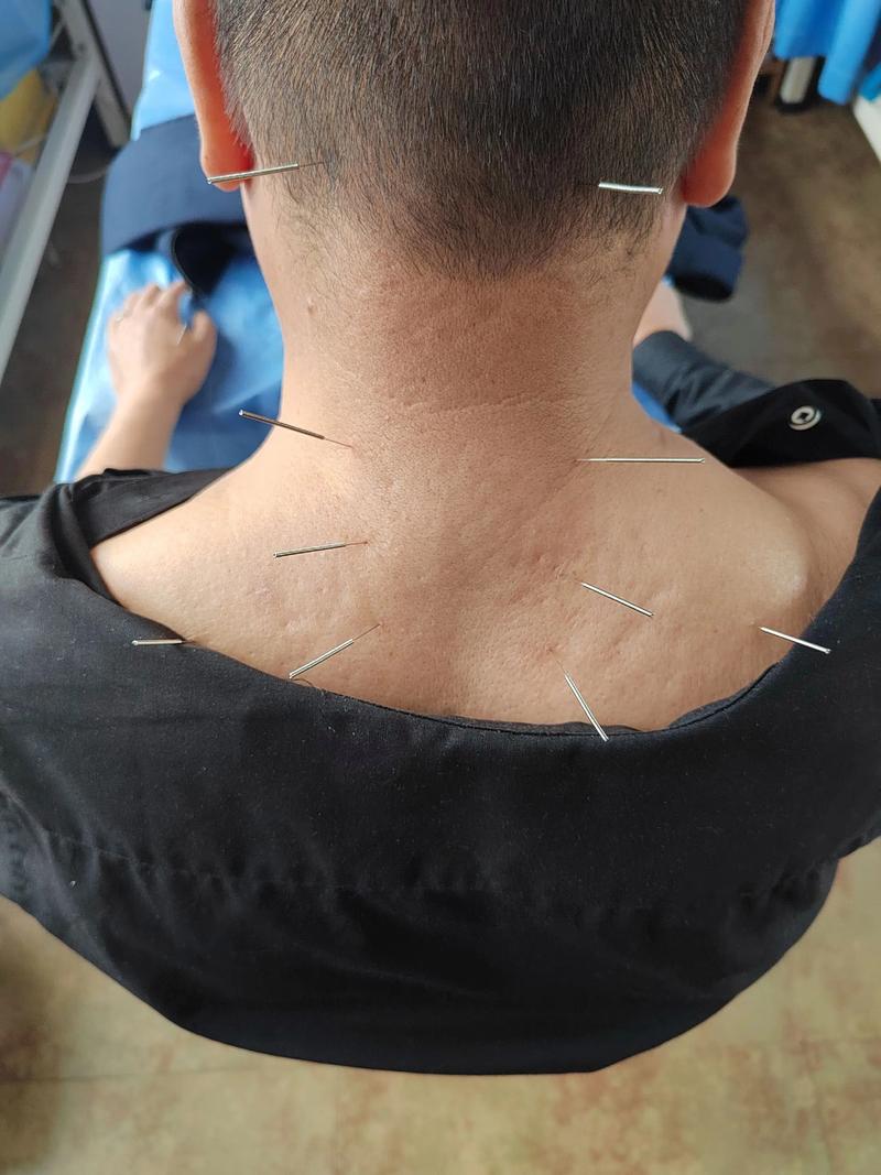 针灸扎到神经的症状