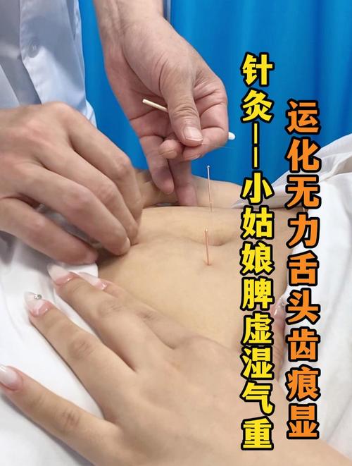 脾虚体湿 针灸效果