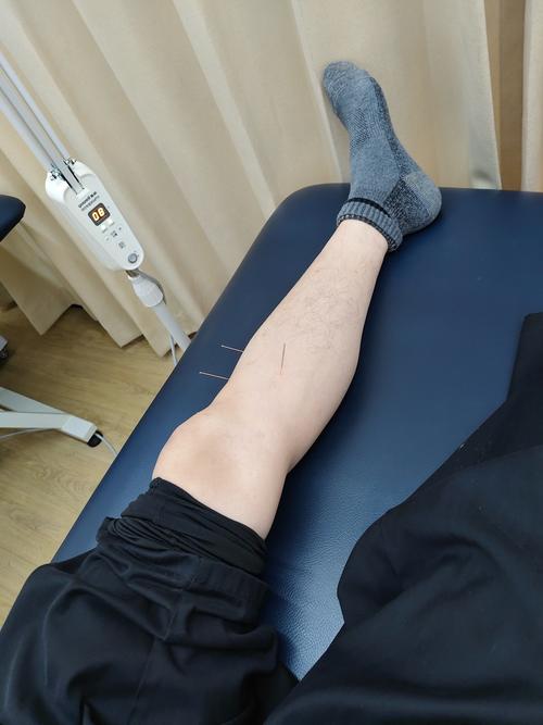 脾虚体湿 针灸效果