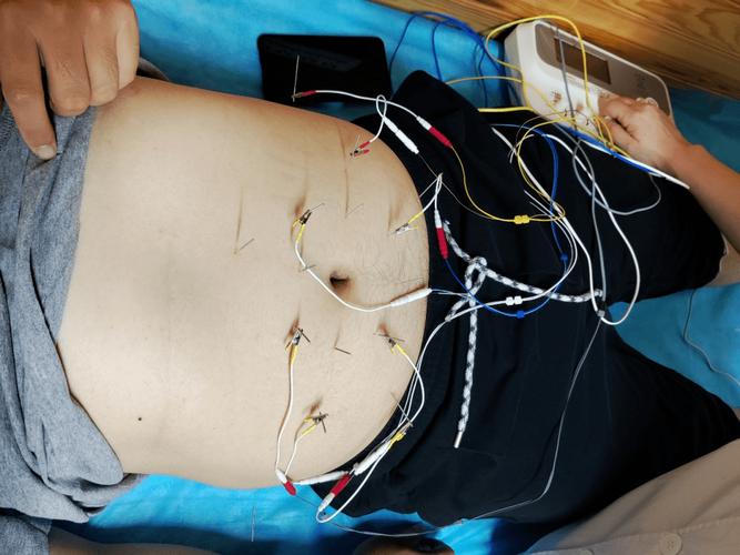 密云针灸减肥那家好