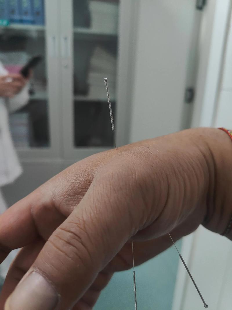 针灸可以连续扎多久