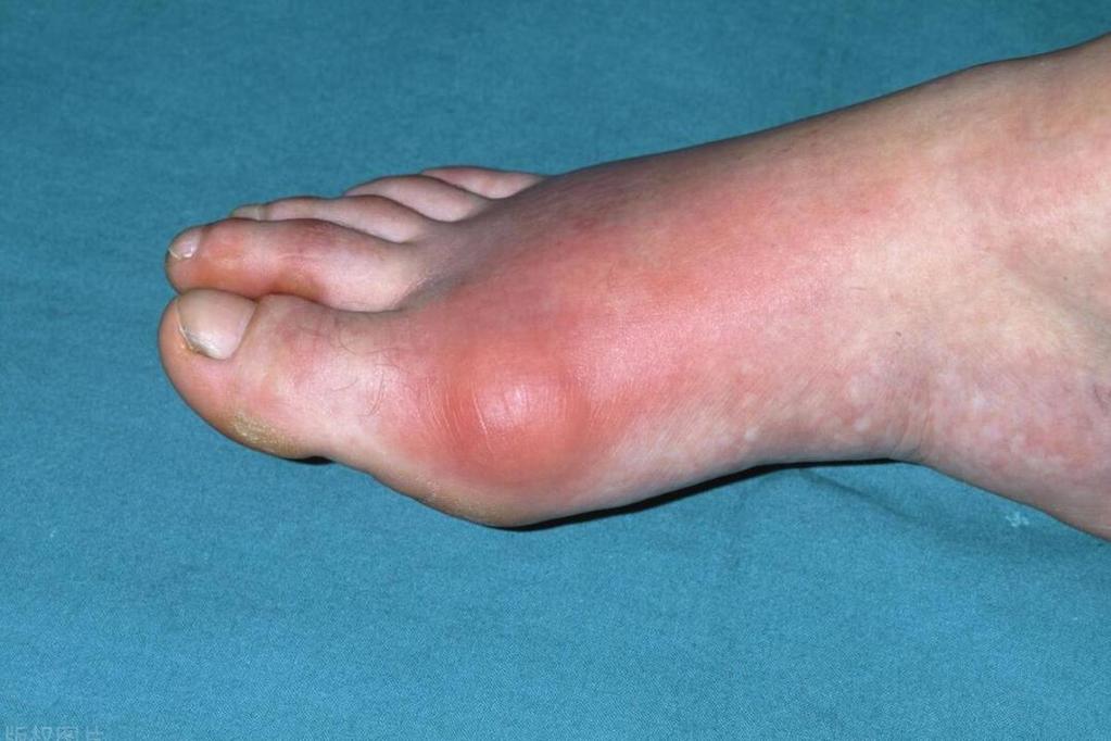 早期痛风症状图片大全