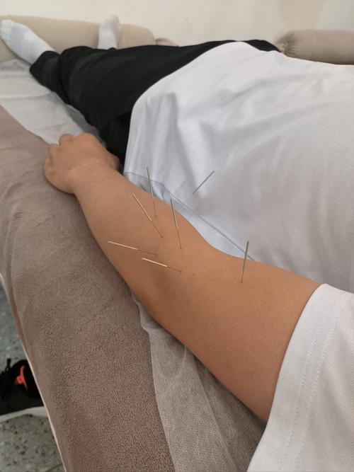 湘潭哪里有正规针灸