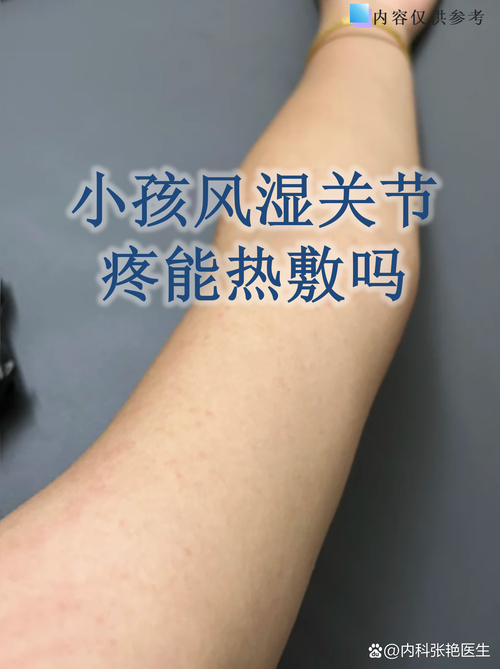 痛风应该热敷还是冷敷