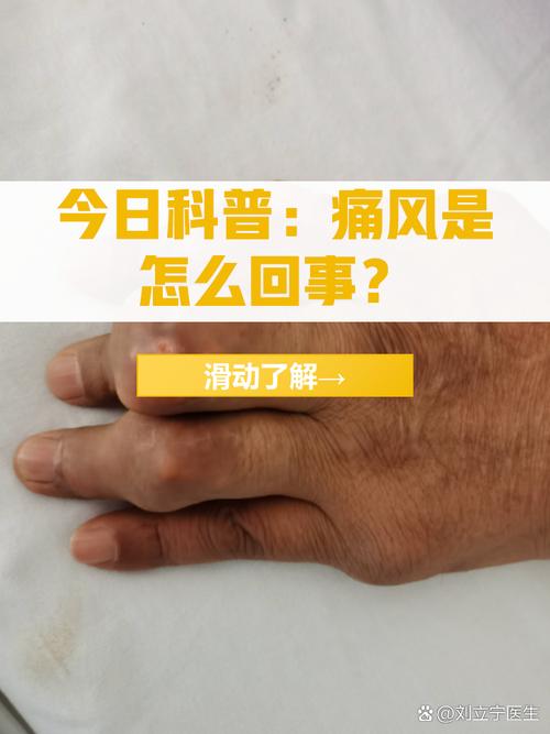尿酸500多是痛风吗