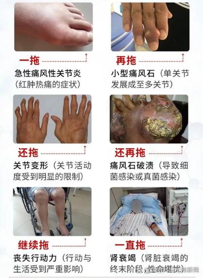 痛风转移说明加重了吗