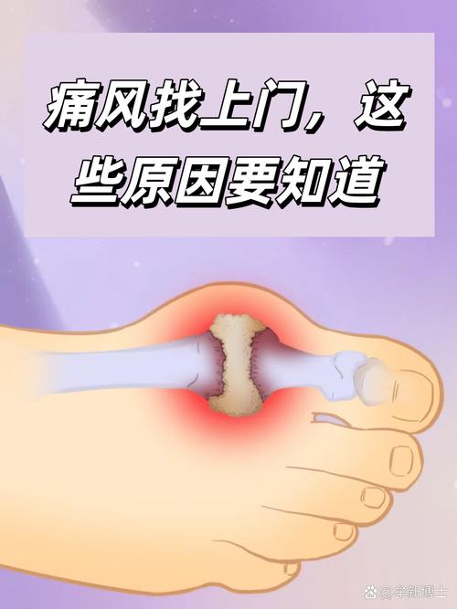 痛风转移说明加重了吗