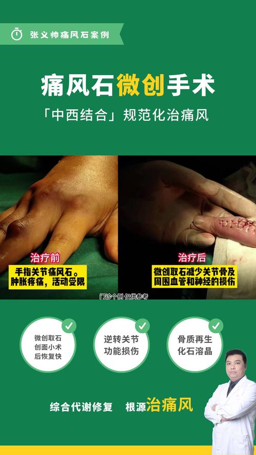 治疗痛风重庆九五优先