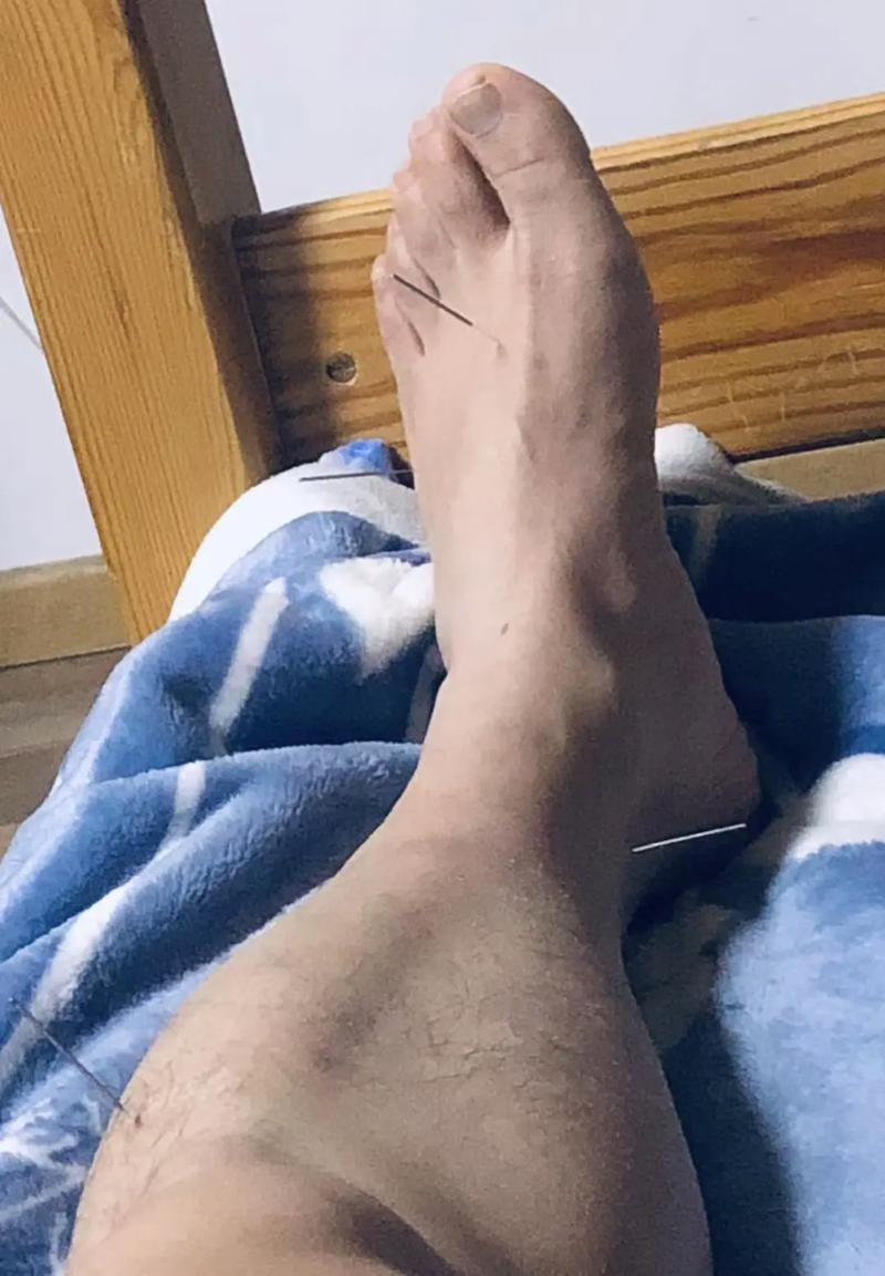 针灸好了后又回去了