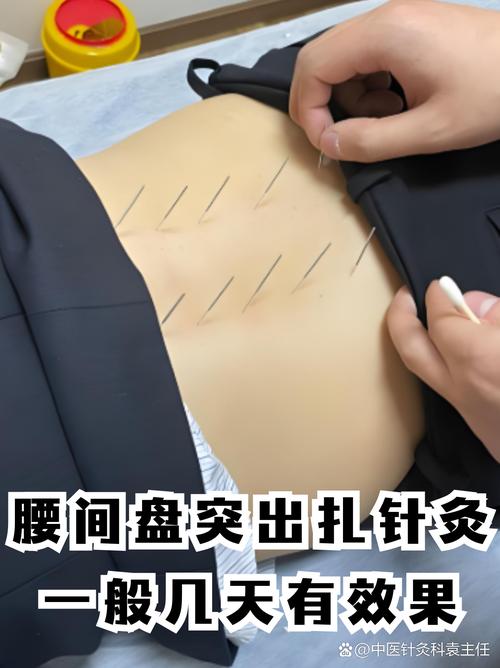 腰部扭伤可以针灸吗