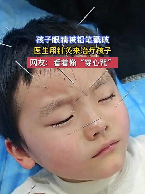 眼部针灸后视力模糊