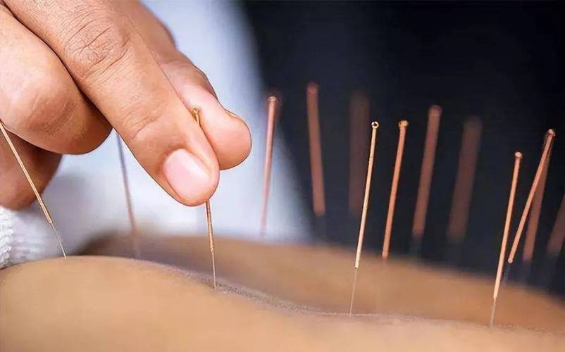 针灸可以治疗妇科吗