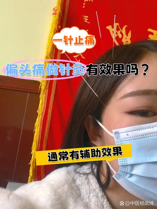 神经头痛可以针灸吗