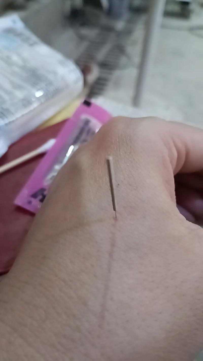 宫颈糜烂的针灸穴位