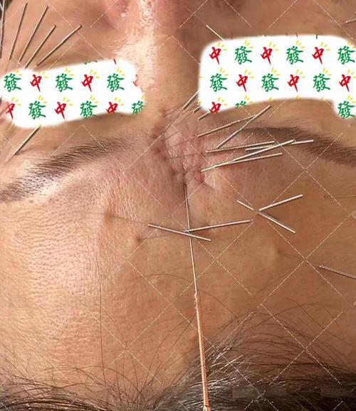 针灸脸部可以提升吗