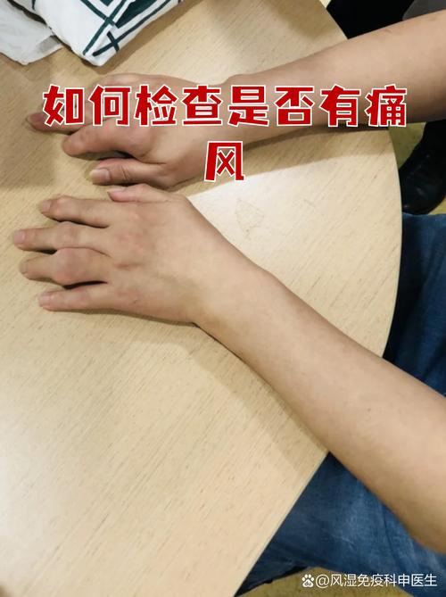 怀疑痛风要做哪些检查