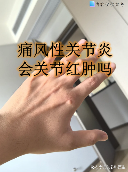 痛风性关节炎是痛风吗