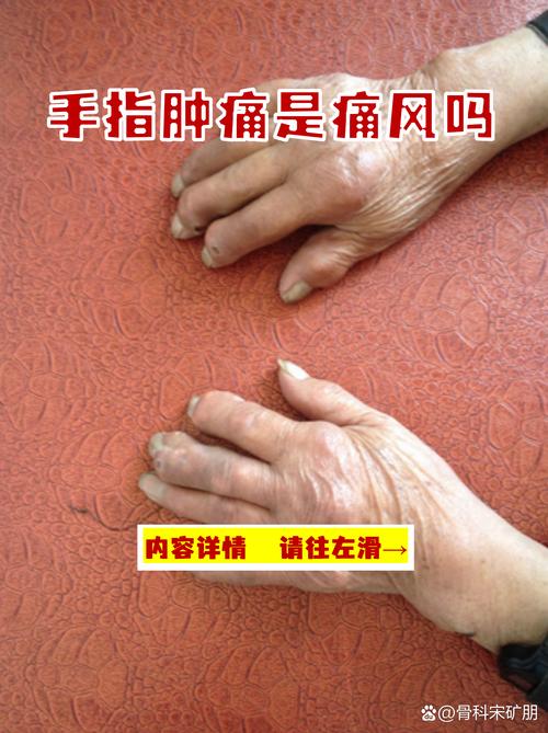 痛风性关节炎是痛风吗