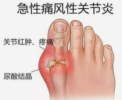 痛风性关节炎是痛风吗