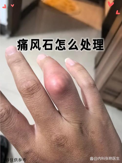 痛风多久会形成痛风石