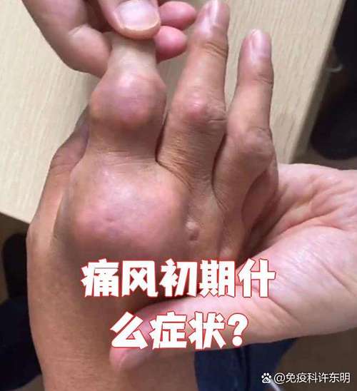 年轻人第一次痛风发作