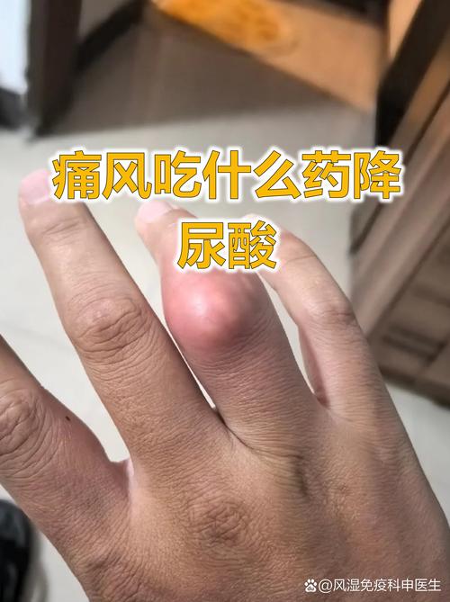 艾瑞昔布片能治痛风吗