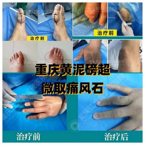 轻酸呤治痛风是真的吗