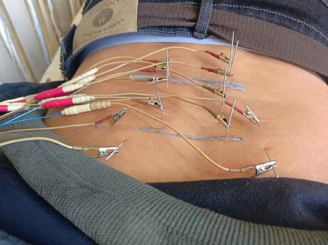 石家庄推拿针灸那有