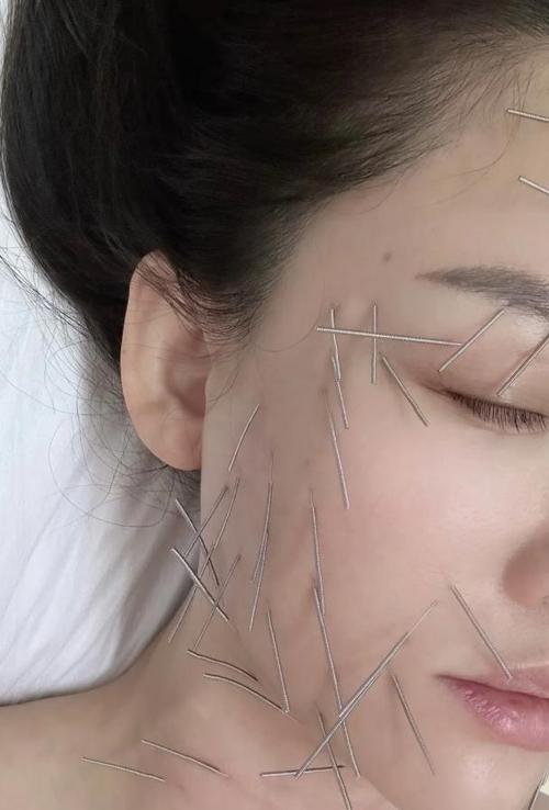 针灸面部提升满脸针