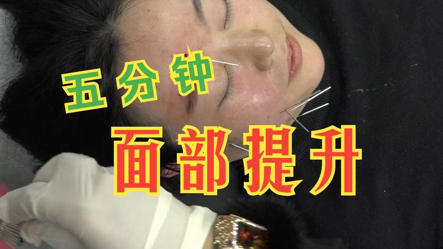 针灸面部提升满脸针