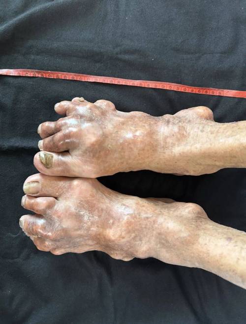 痛风手足泡浴剂有用吗