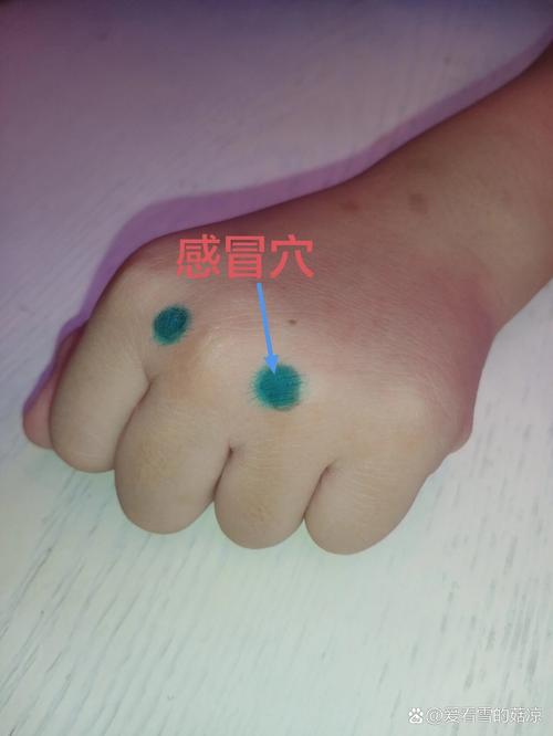 针灸可以治小孩发烧